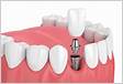 Implante Dentário como se coloca OralME